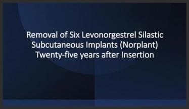 Removal of Six Levonorgestrel Silastic Subcutaneous Implants Twenty-five years After Insertion