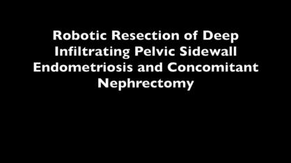 ROBOTIC RESECTION OF DEEP INFILTRATING PELVIC SIDEWALL ENDOMETRIOSIS AND CONCOMITANT NEPHRECTOMY