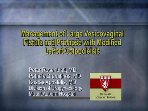 MANAGEMENT OF LARGE VESICOVAGINAL FISTULA AND UTERINE PROLAPSE WITH MODIFIED LEFORT COLPOCLEISIS