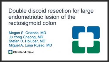 Double discoid resection for large endometriotic lesion of the rectosigmoid colon