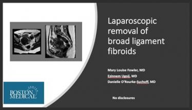 Laparoscopic Removal of Broad Ligament Fibriods
