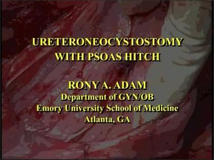 Ureteroneocystostomy with Psoas Hitch