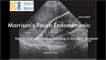 MORRISON’S POUCH ENDOMETRIOSIS: A STEP-BY-STEP APPROACH TO OPERATING IN THE UPPER ABDOMEN