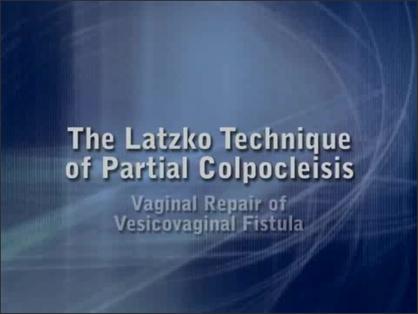 Latzko Partial Colpocleises for Post Hysterectomy Vesicovaginal Fistula