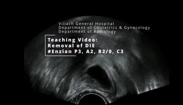 Teaching Video: Removal of DIE (#Enzian P3, A2, B2/0, C3)