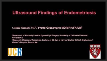 Ultrasound Findings of Endometriosis