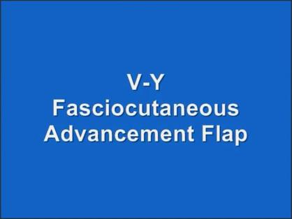 V-Y FASCIOCUTANEOUS ADVANCEMENT FLAP FOR COVERAGE OF LARGE VULVAR DEFECTS