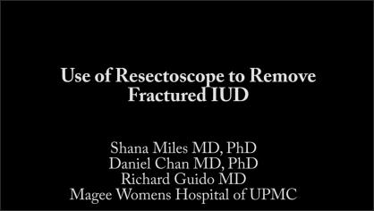 USE OF RESECTOSCOPE TO REMOVE FRACTURED INTRAUTERINE DEVICE (IUD)