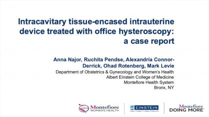 Intracavitary Intrauterine Device Encased in Tissue Treated With Office Hysteroscopy: A Case Report