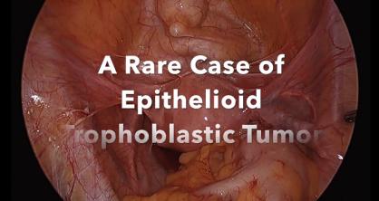 A Rare Case of Epithelioid Trophoblastic Tumor