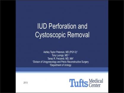 INTRAUTERINE DEVICE (IUD) PERFORATION AND CYSTOSCOPIC REMOVAL