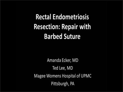 RECTAL ENDOMETRIOSIS RESECTION: REPAIR WITH BARBED SUTURE