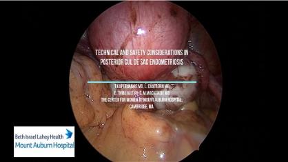 TECHNICAL AND SAFETY CONSIDERATIONS IN POSTERIOR CUL DE SAC ENDOMETRIOSIS