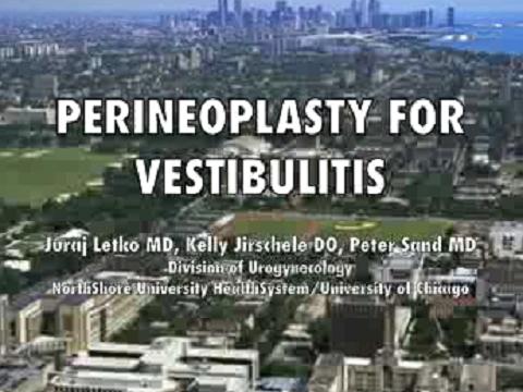 PERINEOPLASTY FOR VESTIBULITIS: EDUCATIONAL VIDEO