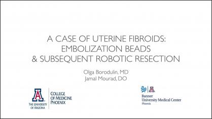 A Case of Uterine Fibroids: Embolization Beads & Subsequent Robotic Resection