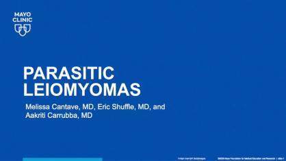 Parasitic Leiomyomas