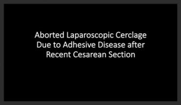 ABORTED LAPAROSCOPIC CERCLAGE DUE TO ADHESIVE DISEASE AFTER RECENT CESAREAN SECTION