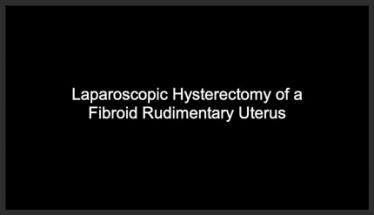 Laparoscopic hysterectomy of a rudimentary fibroid uterus