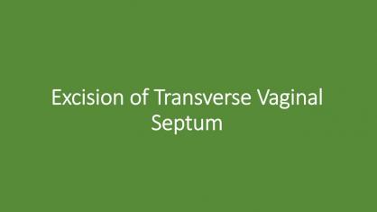 Excision of Transverse Vaginal Septum