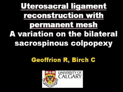 UTEROSACRAL LIGAMENT RECONSTRUCTION WITH PERMANENT MESH-A VARIATION ON THE BILATERAL SACROSPINOUS CO