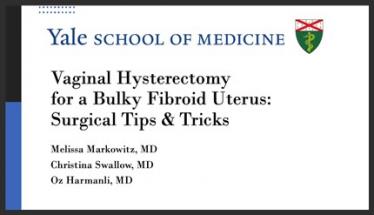 Vaginal Hysterectomy for a Bulky Fibroid Uterus: Surgical Tips & Tricks