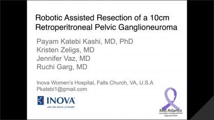ROBOTIC-ASSISTED RESECTION OF A 10 CM RETROPERITONEAL PELVIC GANGLIONEUROMA