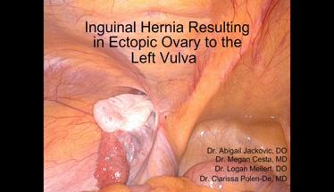 Inguinal Hernia Resulting in Ectopic Ovary to the Left Vulva