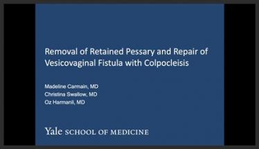Removal of Retained Pessary and Repair of Vesicovaginal Fistula With Colpocleisis