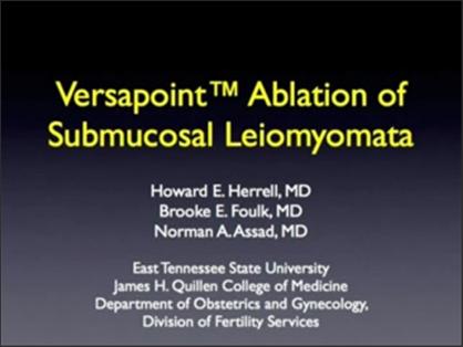 Versapoint Ablation of Submucosal Leiomyomata