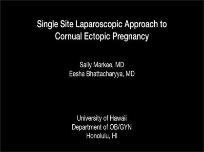 Single Site Laparoscopic Approach to Cornual Ectopic Pregnancy