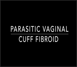 Parasitic vaginal cuff fibroid