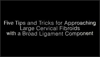 FIVE TIPS AND TRICKS FOR APPROACHING LARGE CERVICAL FIBROIDS WITH A BROAD LIGAMENT COMPONENT