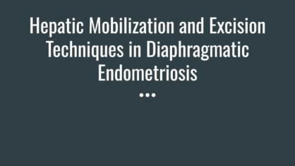 Expanding the Gynecologic Surgeon’s Toolbox: Liver Mobilization for Complete Excision of Diaphragmat