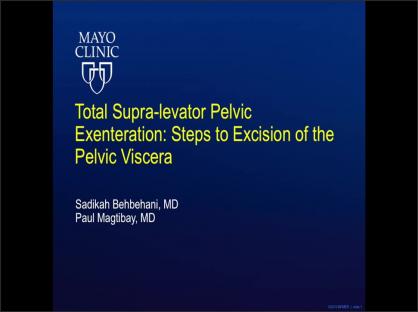Total supralevator pelvic exenteration: Steps to excision of the pelvic viscera